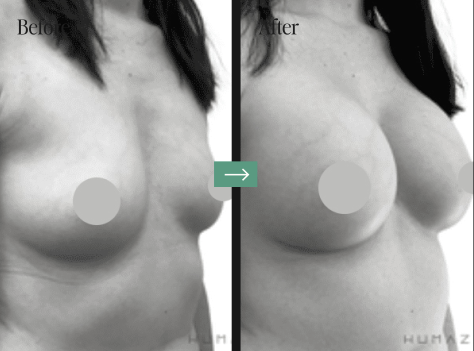 Screenshot 2024-10-10 at 9.14.42 PM Breast Implant Removal Before and After Pictures Charleston, SC